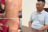 Vụ bé trai 10 tuổi người thâm tím nghi bị bạo hành: Lời khai của bố đẻ